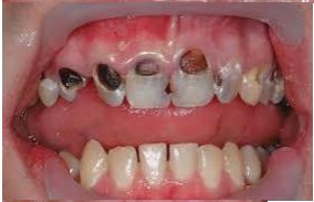 Dental Implants in Vadodara