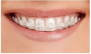 Dental Implants in Vadodara