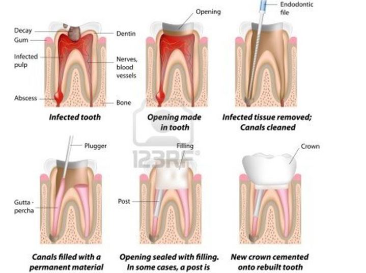 Root Canal Treatment Vadodara