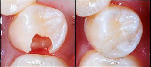 Dental Implants in Vadodara