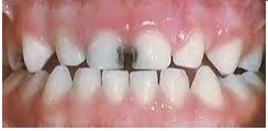 Dental Implants in Vadodara