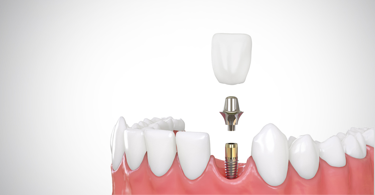 Dental Implants in Vadodara