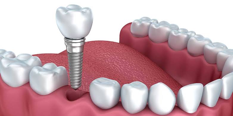 Dental Implants in Vadodara