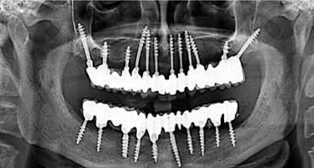 Dental Implants in Vadodara