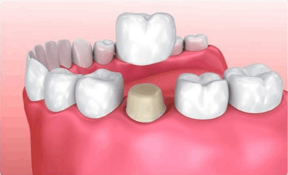 Dental Implants in Vadodara