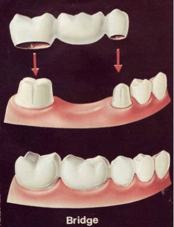 Dental Implants in Vadodara